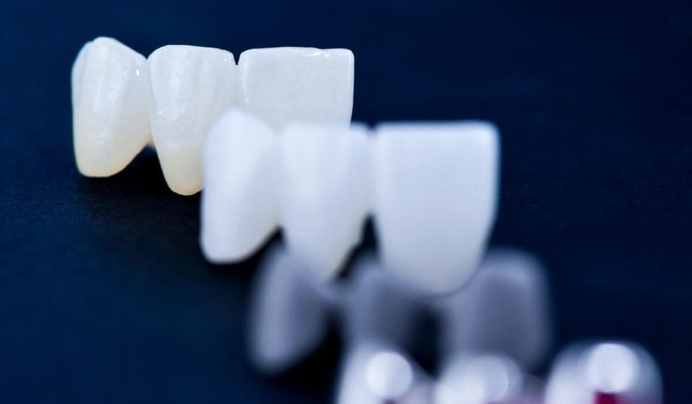 Crowns & Bridges in dental clinic in Poland